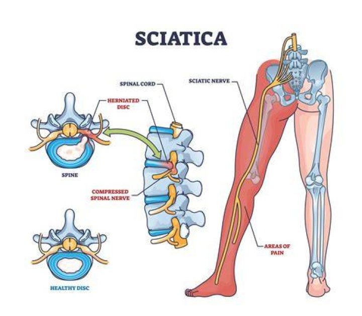 Can sciatica affect neck and shoulders?