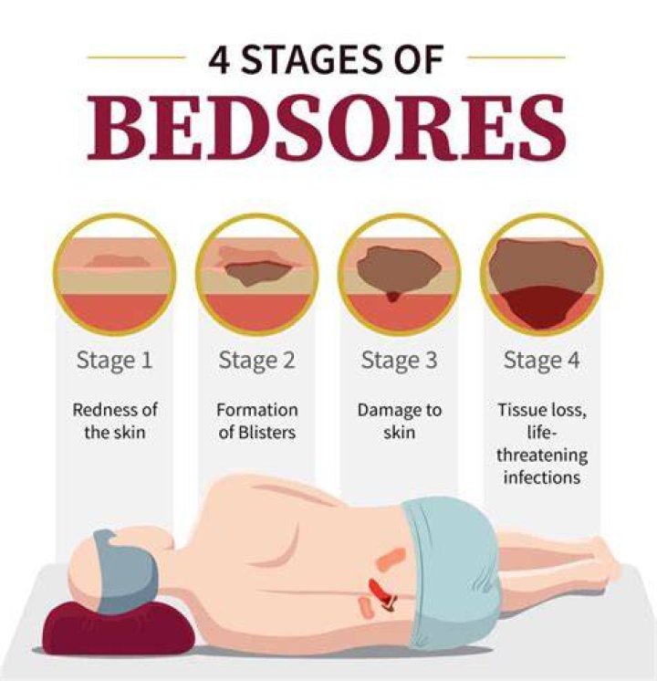 How long can you live with bed sores?