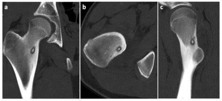 What will response to aspirin osteoid osteoma?